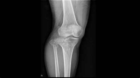 Tibial Plateau Fracture Wikidoc