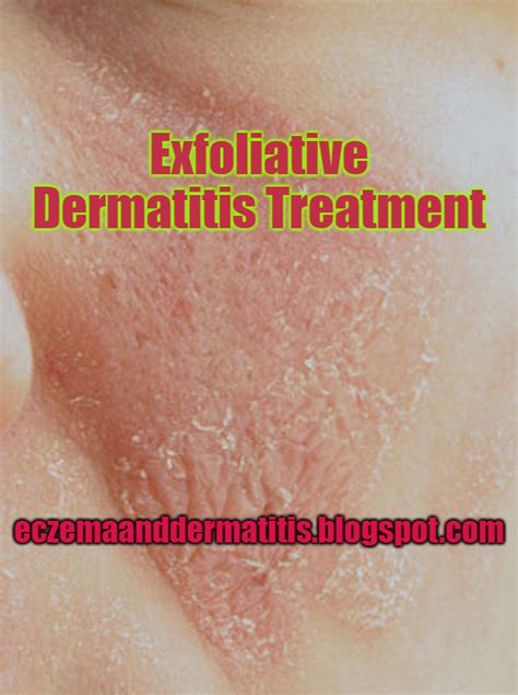 Exfoliative Dermatitis Causes Symptoms And Treatment Beckley Boutique