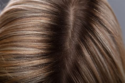 Dry Irritated Scalp Could Be Head Lice Lice Clinics Of Texas