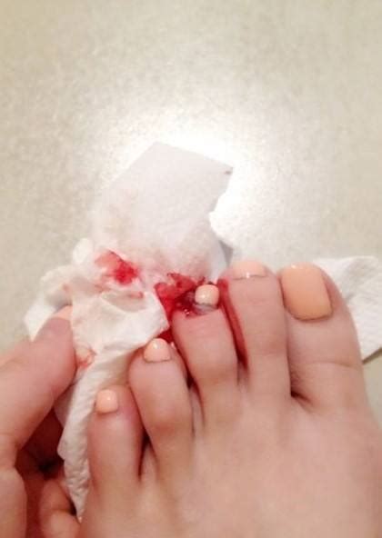 What is the best method to control bleeding? What Do Toe bleeding Symbolize in Dreams and How to ...