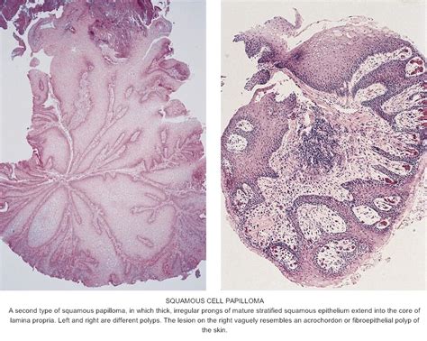 Pathology Outlines Squamous Papilloma