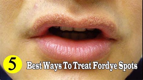 5 Best Ways To Remove Fordyce Spots Naturally At Home Youtube Youtube