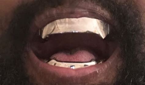 As Kanye West Gets 850000 Titanium Teeth Dentists Issue Warning