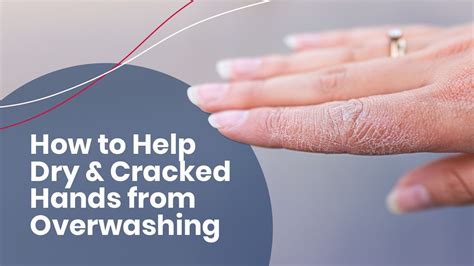 How To Treat Dry And Cracked Hands From Overwashing