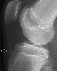 The severity of symptoms depends on how it breaks, which is usually from a tibial fractures are common and usually caused by an injury or repetitive strain on the bone. File:Avulsion fracture of tibial tuberosity.jpg ...