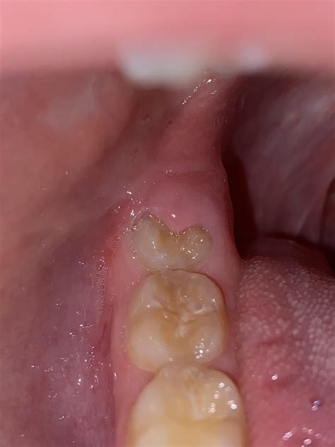 Tooth Is Finally Giving Me Issues Last 4 Dayswondering If This Looks