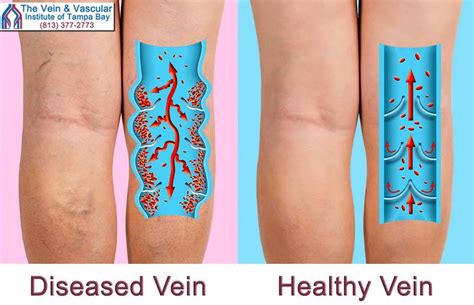 Venous Insufficiency Happens When The Leg Vein Valves Malfunction In