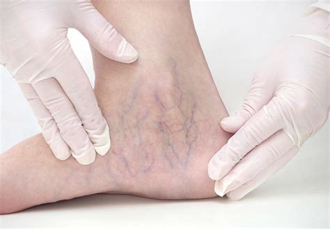 Spider Veins Causes Treatments And More