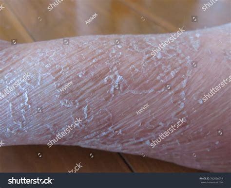 Problem Dry Skin Peeling On Arm库存照片762056014 Shutterstock
