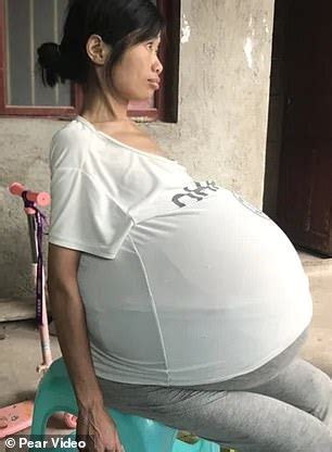 Chinese Woman S Belly Grows To Lbs Due To Mystery Condition Daily Mail Online