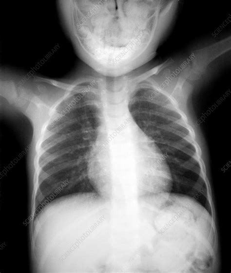 Normal Heart And Lungs Of A Child X Ray Stock Image P5900298