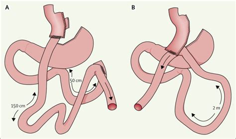 Efficacy And Safety Of One Anastomosis Gastric Bypass Versus Roux En Y