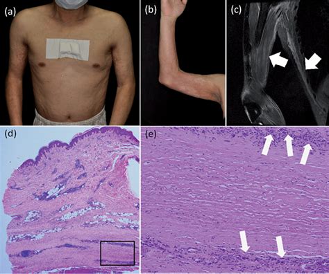 Scleroderma As Related To Eosinophilic Fasciitis Pictures