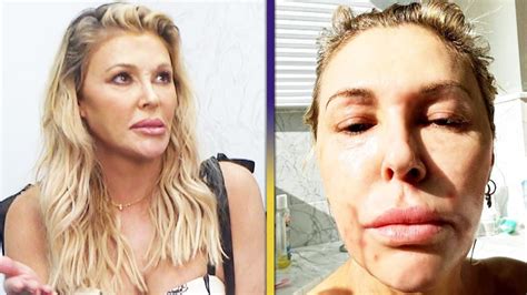 Brandi Glanville Details Facial Disfigurement After Alleged Rhugt Incident With Caroline Manzo