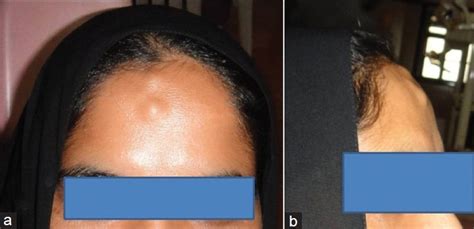 39 Year Old Female With Multiple Bony Hard Swellings On The Forehead