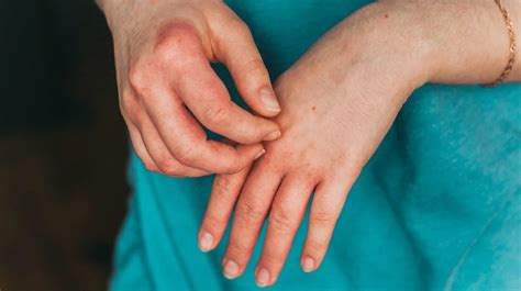 7 Types Of Eczema Symptoms Causes And Pictures