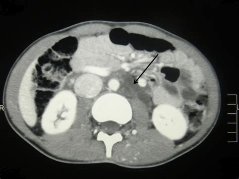 Klippel Trenaunay Syndrome Presenting With Acanthocytosis And Splenic