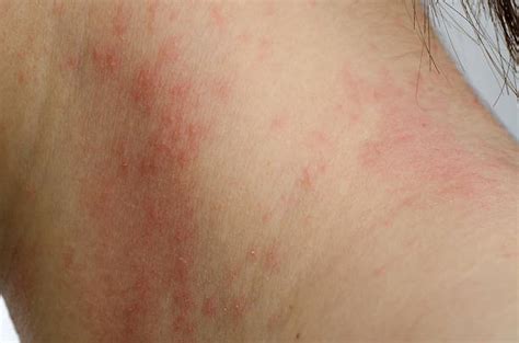 Dermatitis Exfoliativa Banco De Fotos E Imágenes De Stock Istock