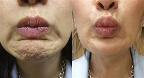 Botox Injection For Frown Lines Before And After