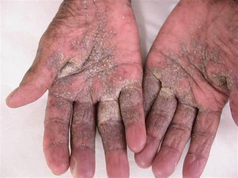 Scabies On Palm Pictures Photos