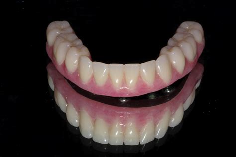 Boise Idaho Prosthodontics: Maxillary Complete Denture / Mandibular 5 ...