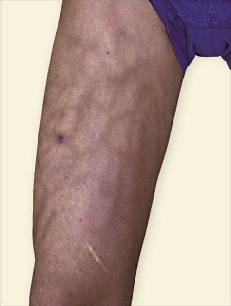 Are Superficial Thrombophlebitis And Deep Vein Thromb Vrogue Co