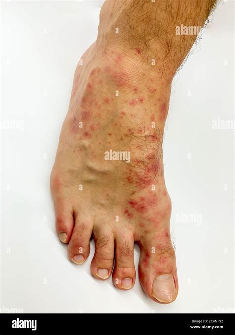 Close Up Of Males Foot And Toes With Red Rash Desease On A White