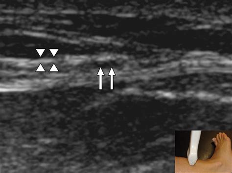 Anatomic Study Of The Superficial Peroneal Nerve Using Sonography Ajr