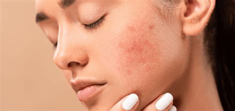 What You Should Know About Acne Healthy Food Near Me