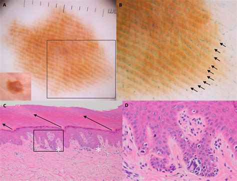 Figure 4 From Dermoscopy For Acral Melanocytic Lesions Revision Of The