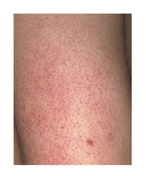 Everything You Should Know About The Bumpy Red Skin On Your Arms Called Keratosis Pilaris