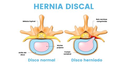 Ejercicios Hernia Discal Ejercicios Para Hernia Discal Hernia Hot My