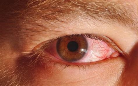 Use Gist Red Bloodshot Eyes Causes Symptom And Treatment