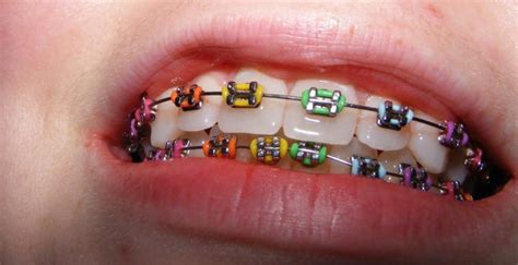 Peut On Faire De La Boxe Avec Un Appareil Dentaire - Couleurs sur les appareils dentaires - Appareil Dentaire