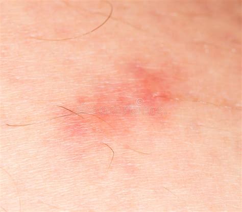 Mosquito Bites On The Skin Close Up Stock Image Image Of Pink