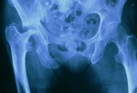 Fcol X Ray Of Osteoarthritis In Pelvis Photograph By Medical Photo Nhs