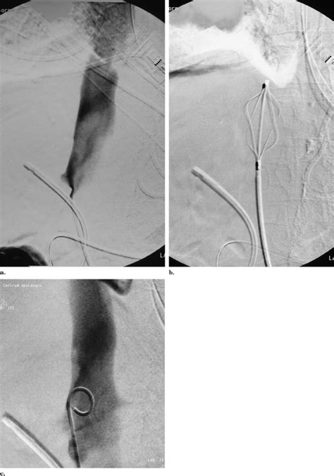 Septic Thrombosis Of The Inferior Vena Cava Treated With Percutaneous