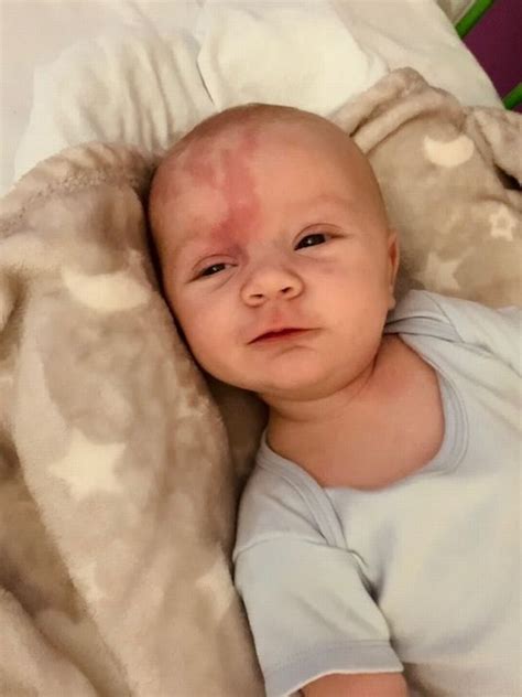 Baby Born With Large Port Wine Stain On Face Diagnosed With Rare