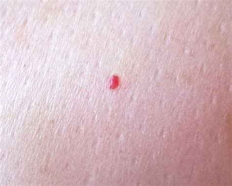 Tiny Pinpoint Red Dots On Skin Not Itchy Polizedge