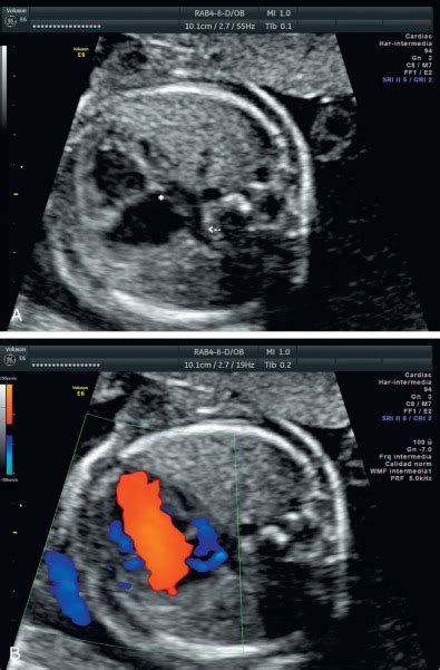 Hypoplastic Left Heart Syndrome And Mitral Atresia Radiology Key