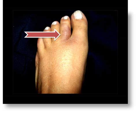 How To Treat An Injured Or Broken Toe By Buddy Taping Healthproadvice
