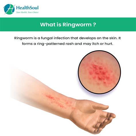 Fungus That Causes Ringworm Ringworm Causes And Risk Factors