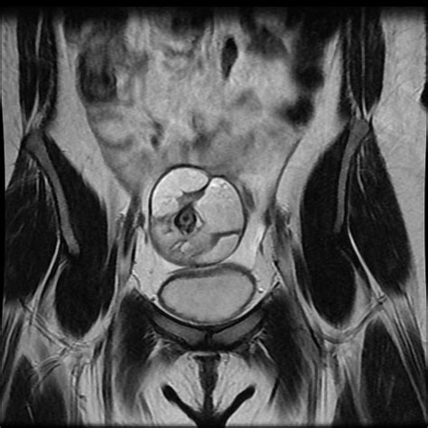 Mature Cystic Ovarian Teratoma Image Radiopaedia Org