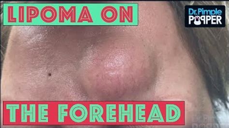 The Extreme Pimple Popping Video That Shocked The Internet New Idea