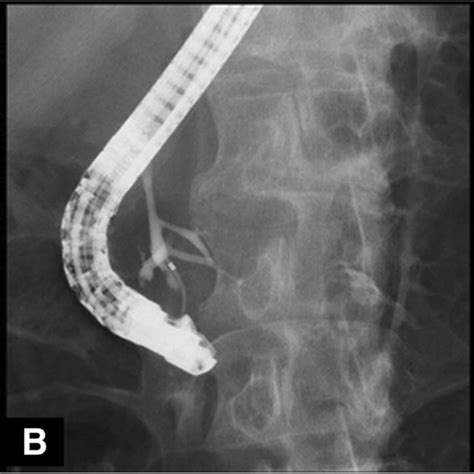 Endoscopic Retrograde Cholangiopancreatography Ercp Ercp From The