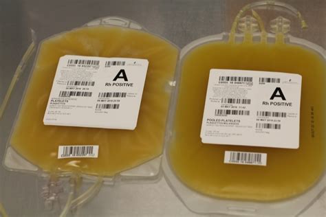 Platelet Transfusion Alloimmunization And Management Of Platelet