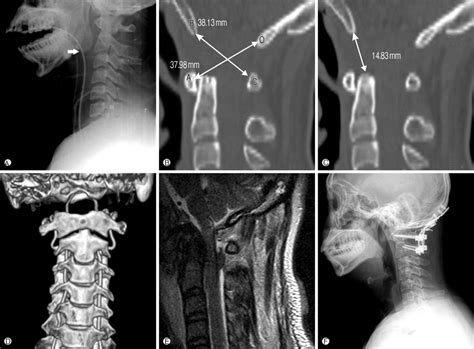A 33 Yr Old Man Sustained An Atlanto Occipital Dislocation A The
