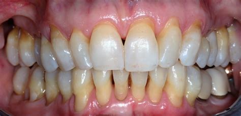 Gum Recession Createsmiles By Dr Brad Lockhart Tustin Dentist