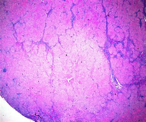 Pathology Outlines Sarcoidosis