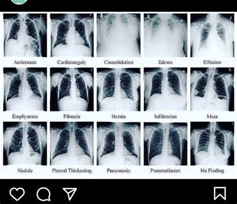 Different Lung Diseases In Radiograph Medizzy